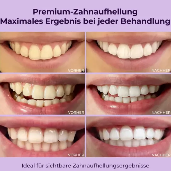ONLYSMILE Zahnbleaching Set professionell 1 St
